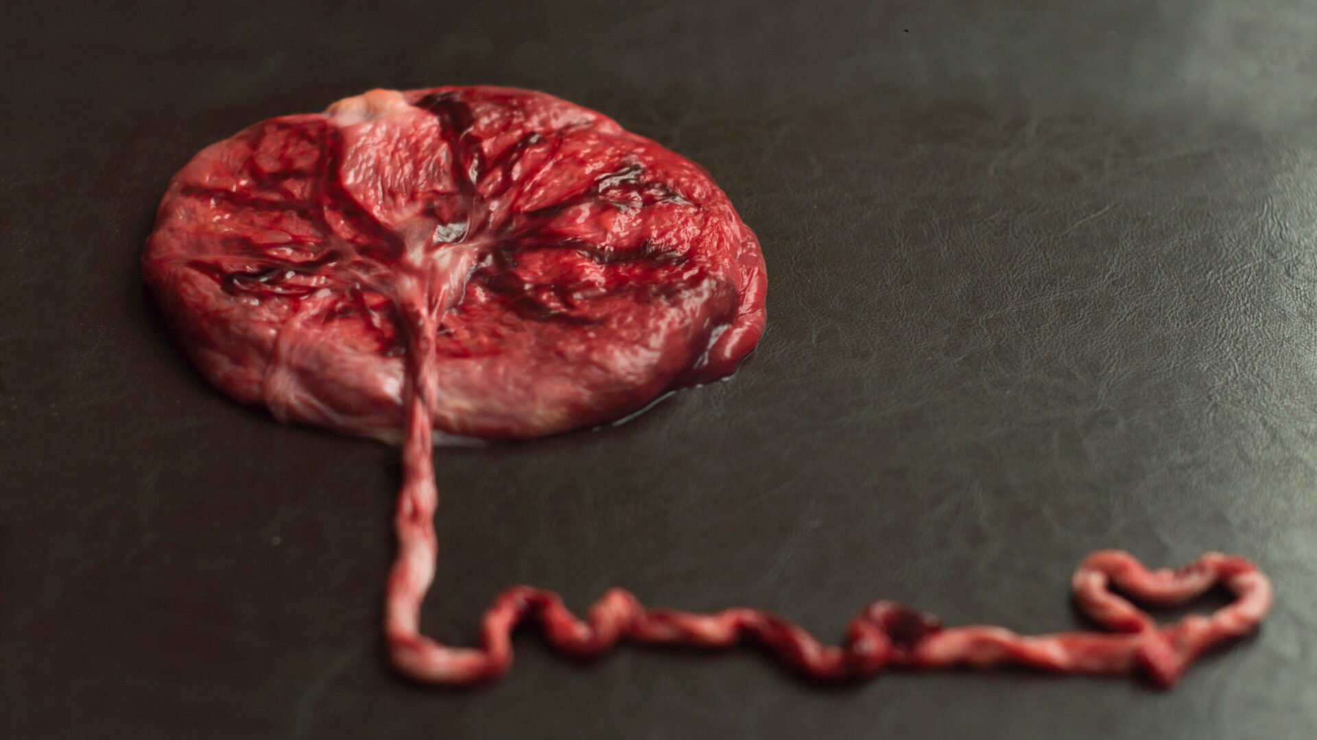 Acretismo Placentário