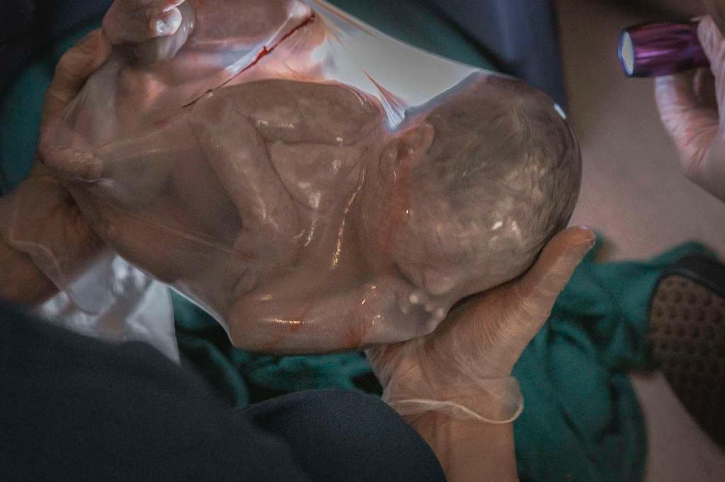 Entenda o fenômeno do Bebê Empelicado
