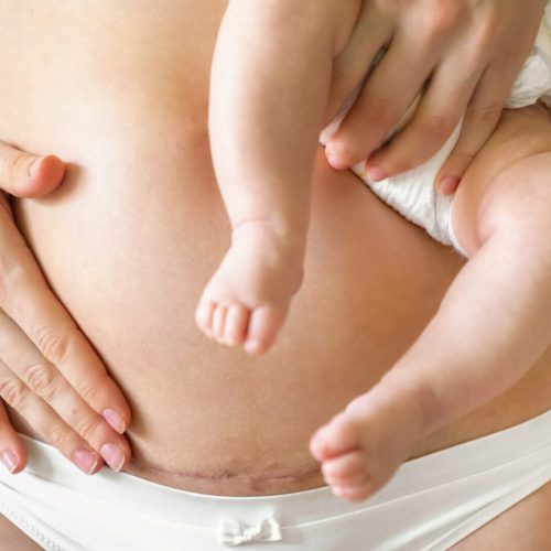 Intervalo entre Cesáreas: Existe tempo ideal?
