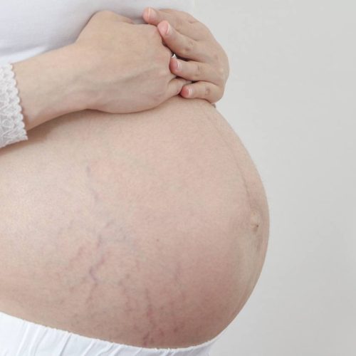 Estrias na gravidez: saiba como se prevenir