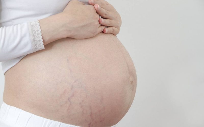 Estrias na gravidez: saiba como se prevenir