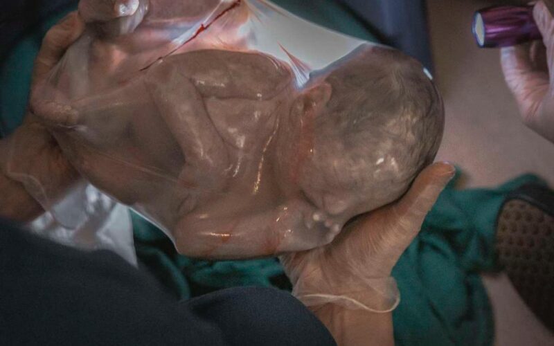 Entenda o fenômeno do Bebê Empelicado