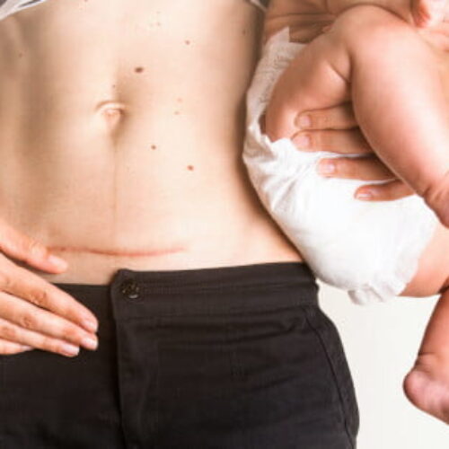 VBAC (Vaginal Birth After Cesarean – Parto Vaginal após cesariana) mitos e verdades sobre o assunto