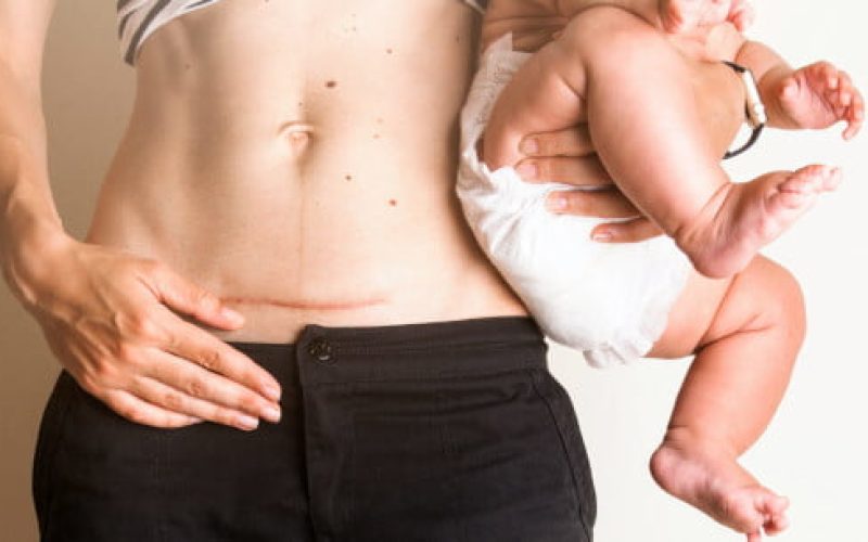 VBAC (Vaginal Birth After Cesarean – Parto Vaginal após cesariana) mitos e verdades sobre o assunto